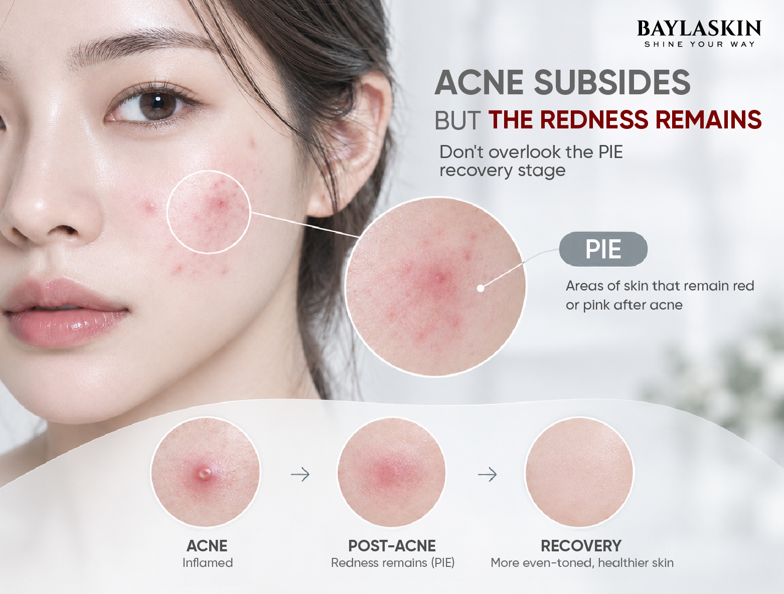 Acne Management Strategy: From Biological Causes and PIE Red Marks to Why You Need a Peptide Recovery Anti-Acne Serum